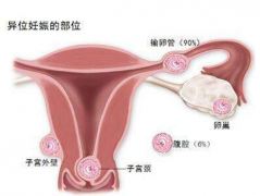 【宫外孕概率有多大】宫外孕的概率有多高_宫外