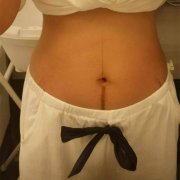 怀孕后肚子上的“黑线”是什么？妊娠中线的秘